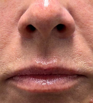 Lip Lift