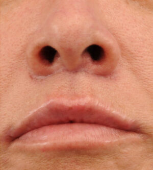 Lip Lift