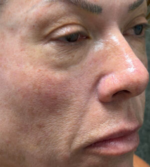 Lip Lift