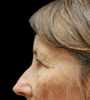 Eyelid Surgery