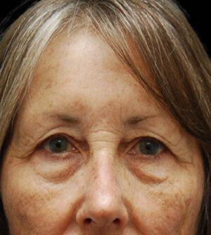 Eyelid Surgery
