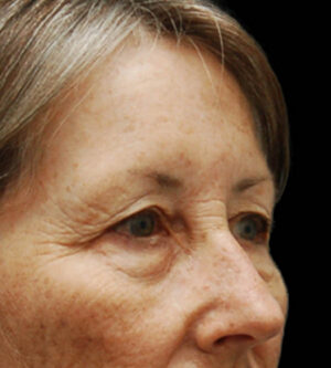 Eyelid Surgery