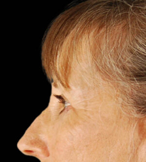 Eyelid Surgery