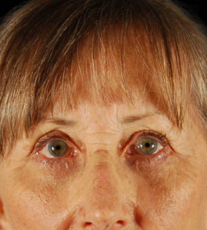 Eyelid Surgery