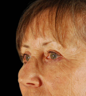 Eyelid Surgery