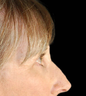 Eyelid Surgery