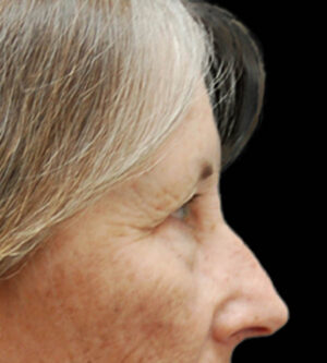 Eyelid Surgery