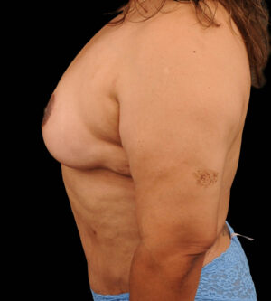 Breast Lift