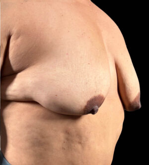 Breast Lift