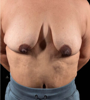 Breast Lift